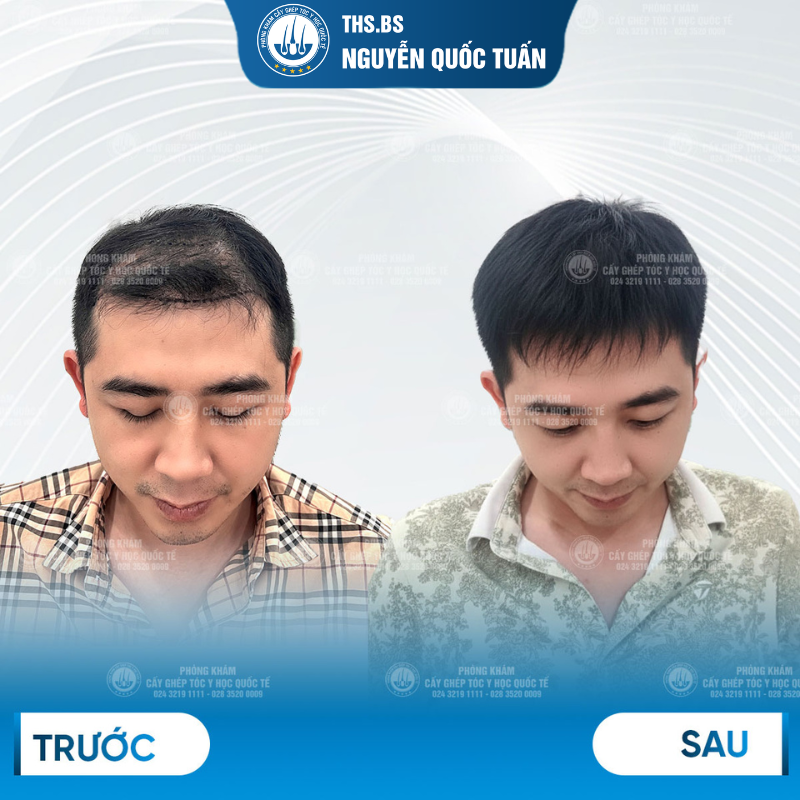 Cấy tóc đỉnh đầu bao lâu mọc đẹp  