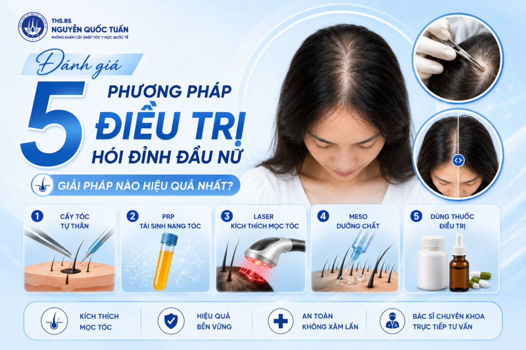 phương pháp trị hói đỉnh đầu nữ