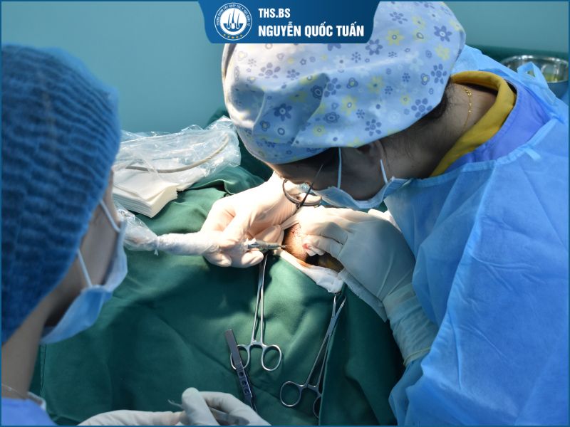 Cấy ghép tóc tự thân 