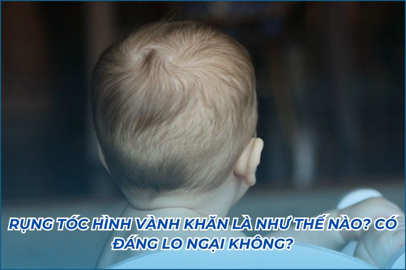 rụng tóc vành khăn là gì