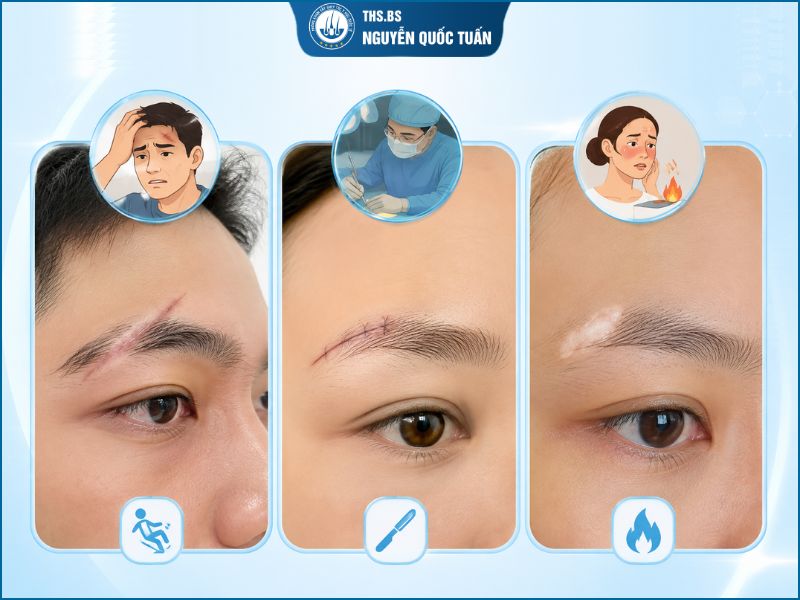 Trường hợp có thể cấy lông mày bị sẹo