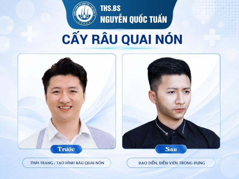 Kết quả cấy râu diễn viên Trọng Hưng 