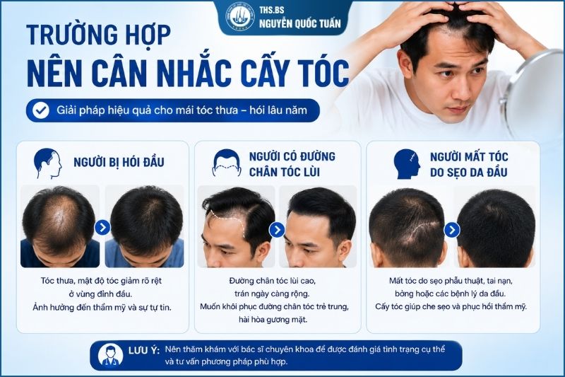 Nhận biết những trường hợp có thể cân nhắc cấy tóc 