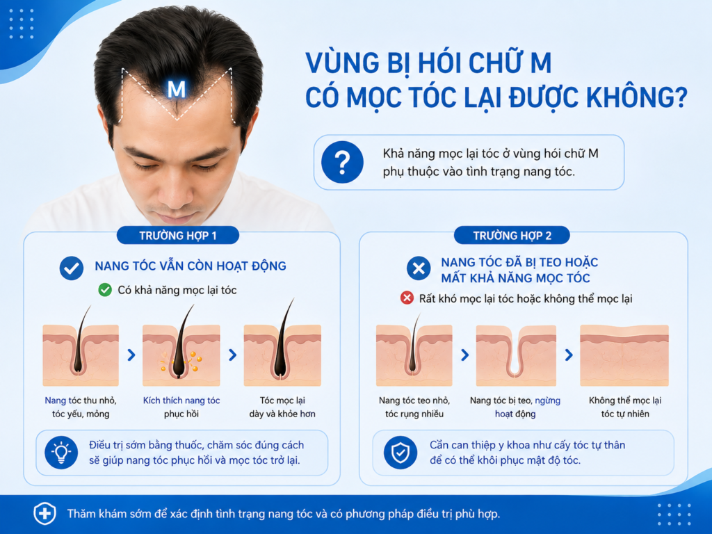 Vùng bị hói chữ M có mọc tóc lại được không? 