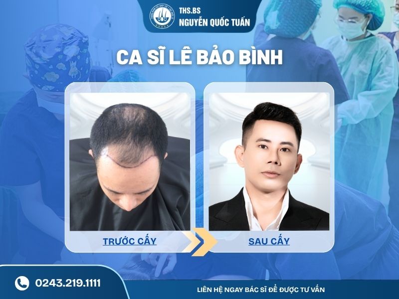 Ca sĩ Lê Bảo Bình cấy tóc cải thiện hói chữ M 