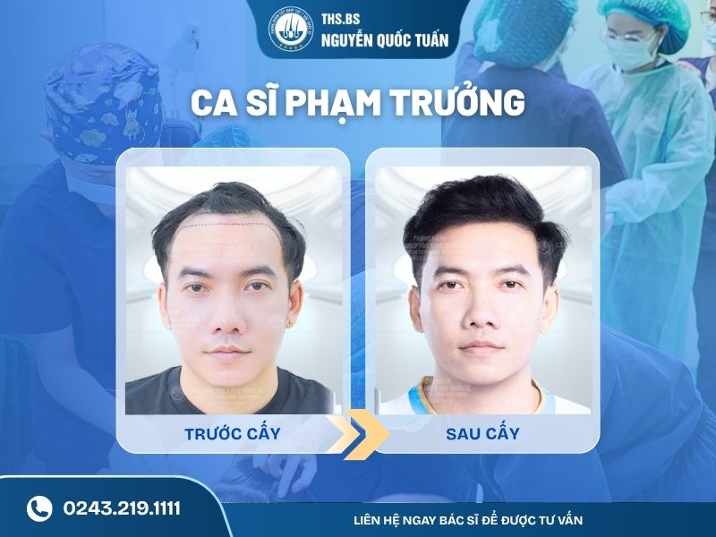 Ca sĩ Phạm Trưởng cấy 3.000 nang tóc cải thiện hói chữ M 