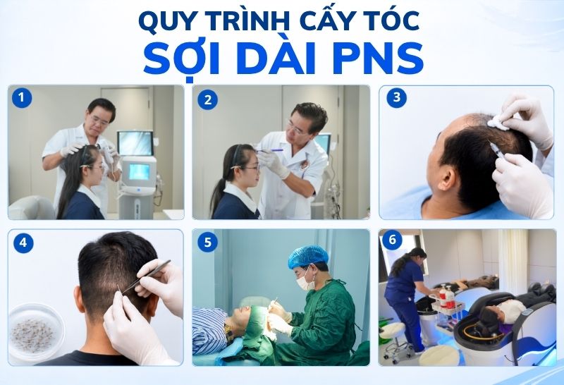 Quy trình cấy sợi dài PNS 
