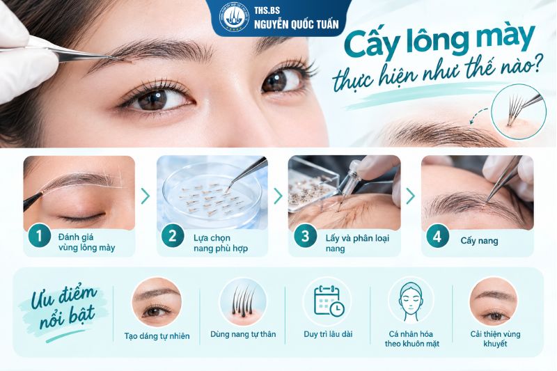 Cấy lông mày được thực hiện như thế nào?  