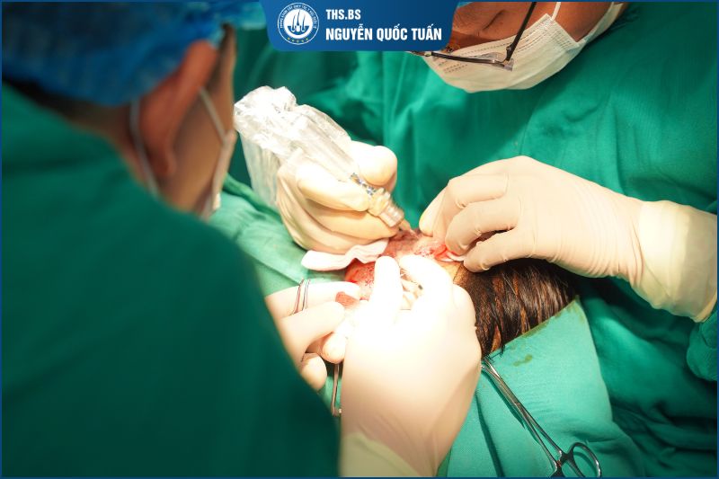 Cấy lông mày tự thân có đau không