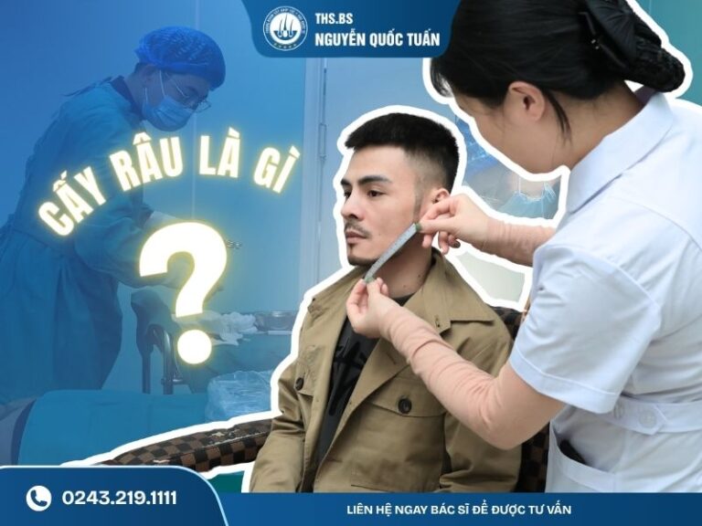 cấy râu là gì