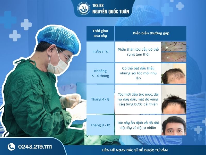 Cấy tóc bao lâu thì bắt đầu mọc lại 