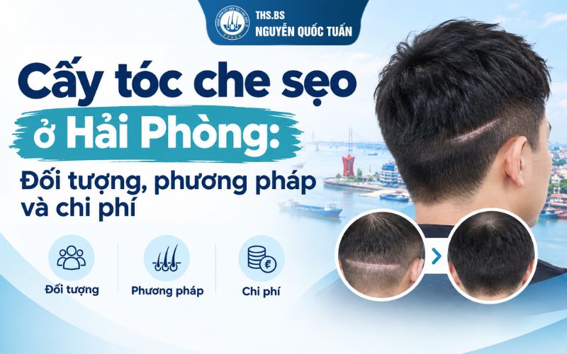 cấy tóc che sẹo ở hải phòng