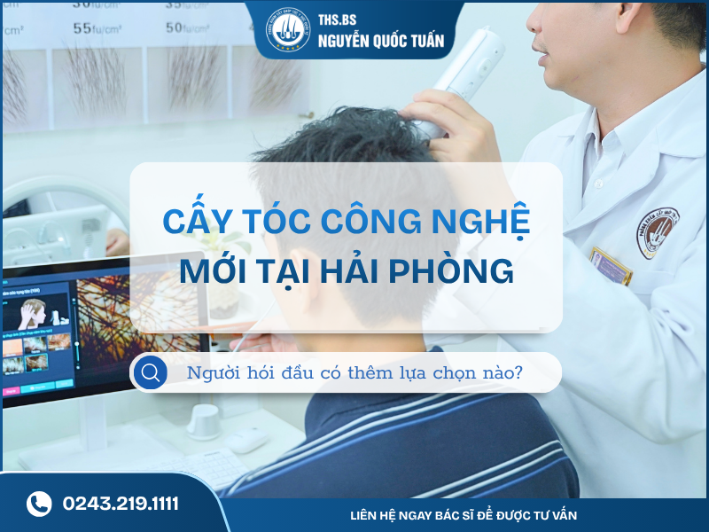 cấy tóc công nghệ mới tại hải phòng