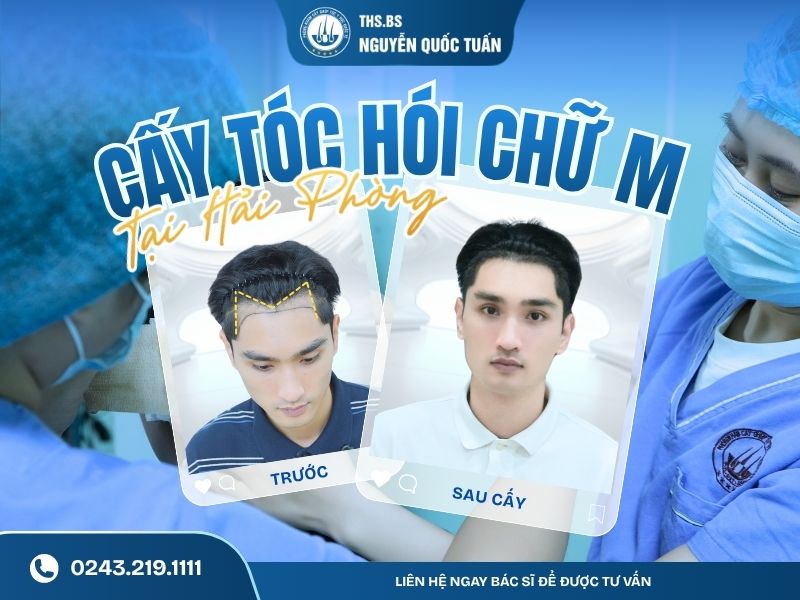 cấy tóc hói chữ m tại hải phòng