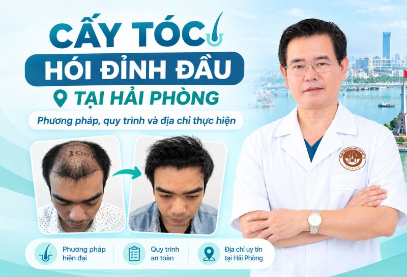 cấy tóc hói đỉnh đầu tại hải phòng