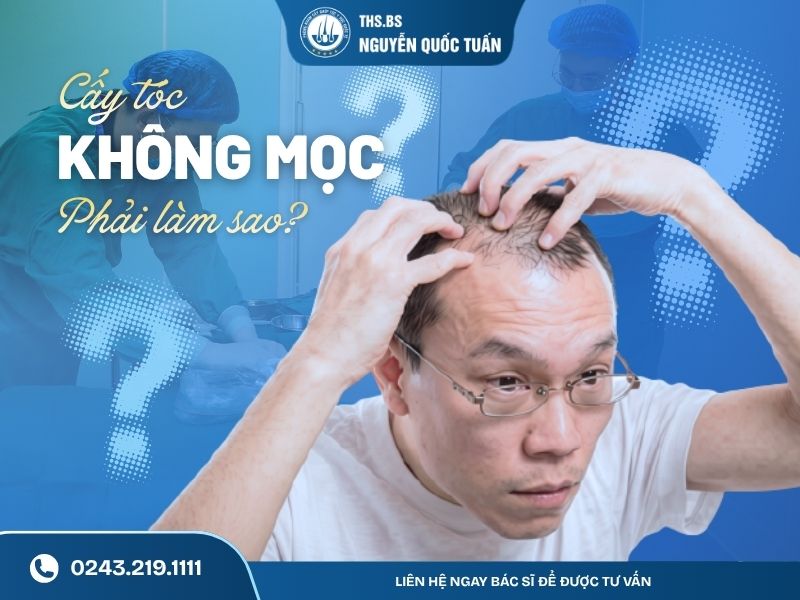 cấy tóc không mọc phải làm sao