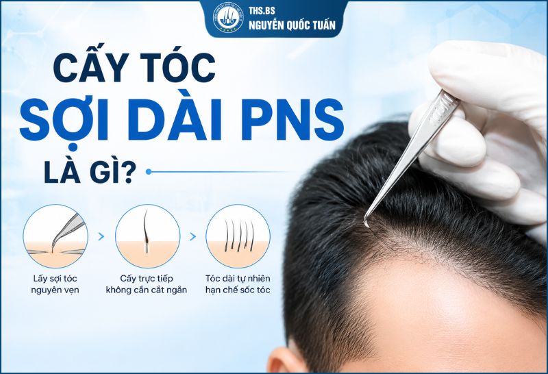 Cấy tóc sợi dài PNS là gì 