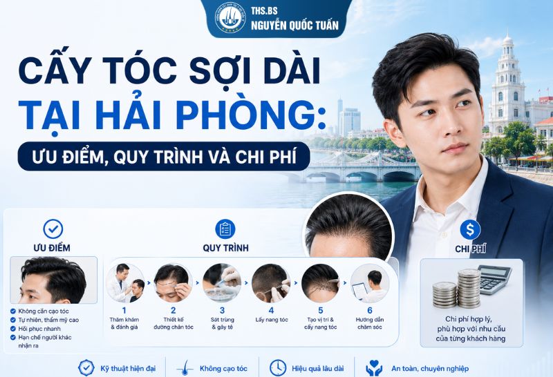 cấy tóc sợi dài tại hải phòng