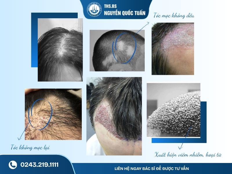 Dấu hiệu nhận biết ca cấy tóc thất bại