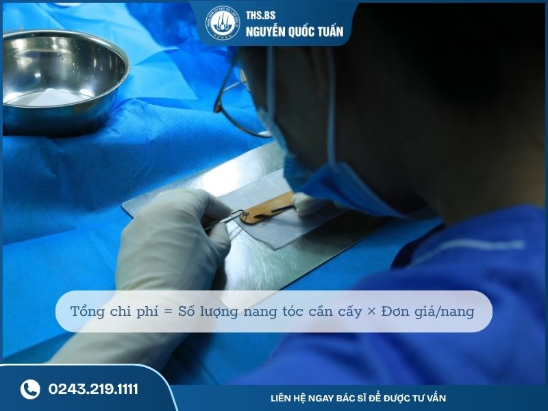Chi phí cấy tóc được tính như thế nào?