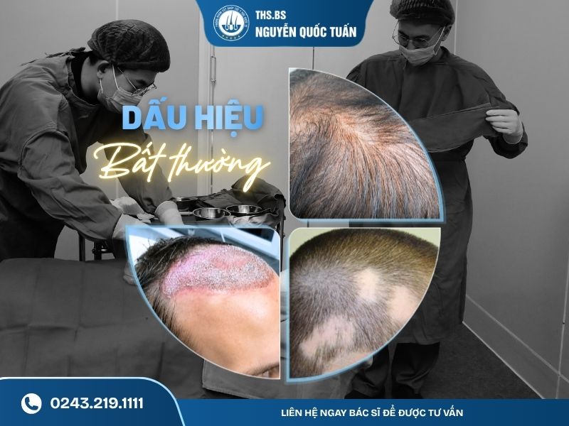 Khi nào cấy tóc không mọc là dấu hiệu bất thường 