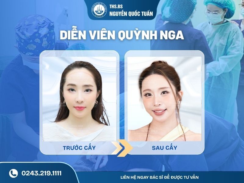  Diễn viên Quỳnh Nga cấy tóc hạ đường chân tóc 