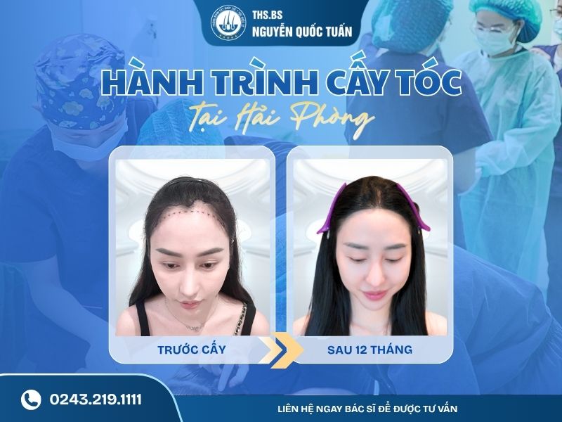 hành trình cấy tóc tại hải phòng