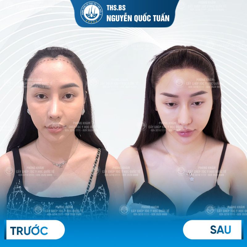 Hiệu quả sau cấy tóc tự thân  