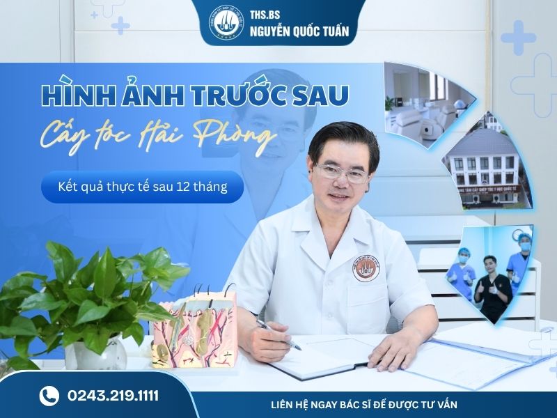 hình ảnh trước và sau cấy