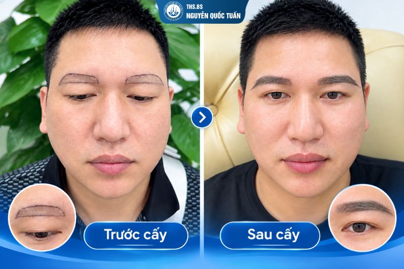 Kết quả cấy lông mày tại Phòng Khám Cấy Tóc Y Học Quốc Tế  