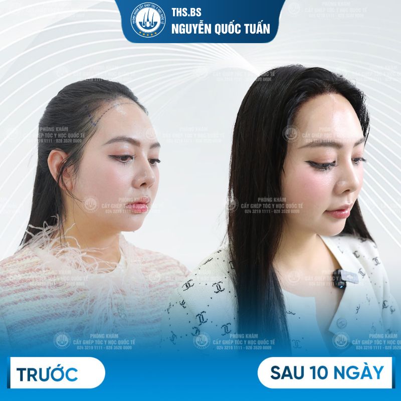 Kết quả sau cấy sợi dài PNS  