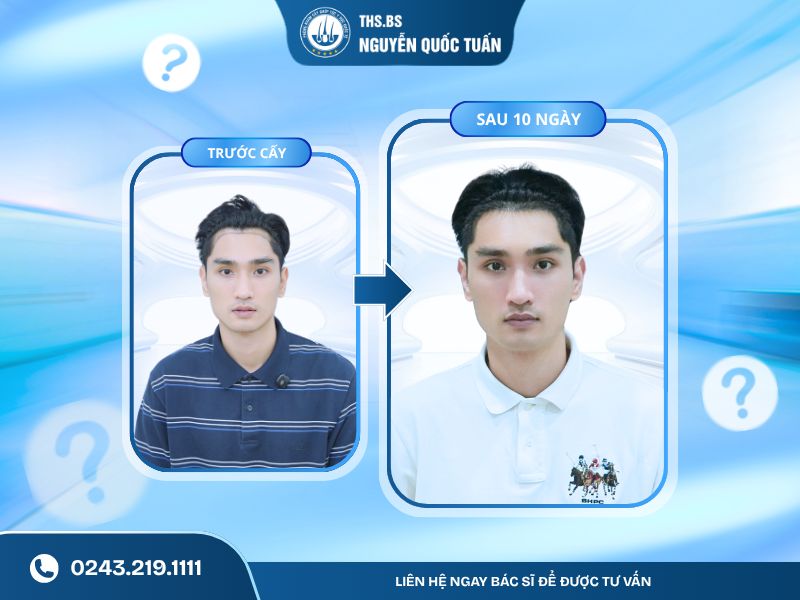 Kết quả cấy tóc công nghệ mới