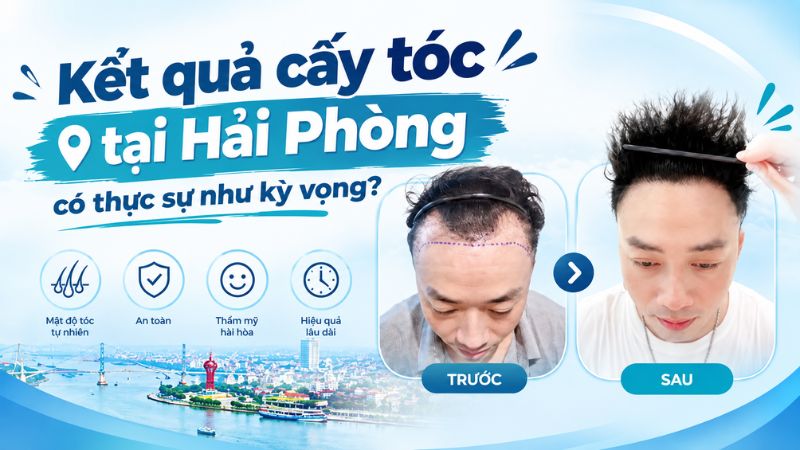 kết quả cấy tóc tại hải ophongf