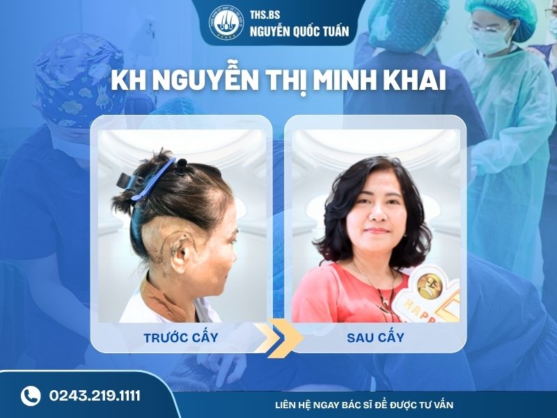 Kết quả sau cấy sẹo cô Minh Khai  