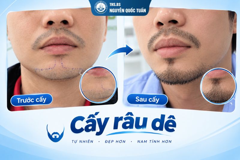 Râu mọc lưa thưa, không đều ở cằm có cải thiện được không 