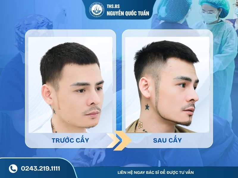 Kết quả sau quá trình cấy râu  
