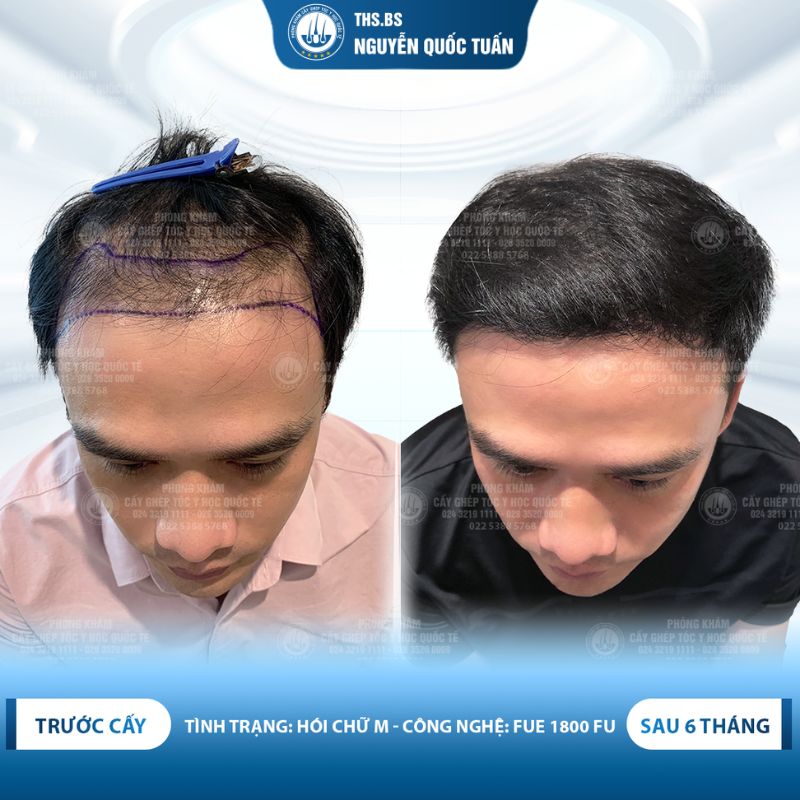 Kết quả sau cấy tóc tại Phòng Khám Cấy Tóc Y Học Quốc Tế 