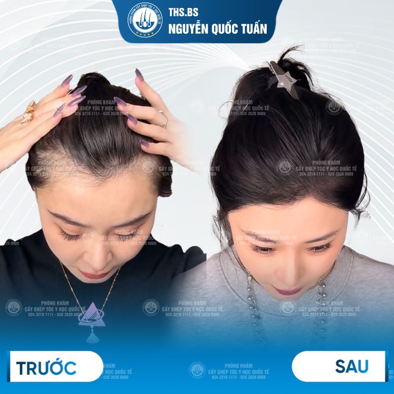 Kết quả sau cấy tại Viện Cấy Tóc Y Học Quốc Tế  
