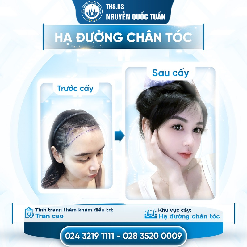 Kết quả cấy tóc tại Phòng Khám Cấy Tóc Y Học Quốc Tế  