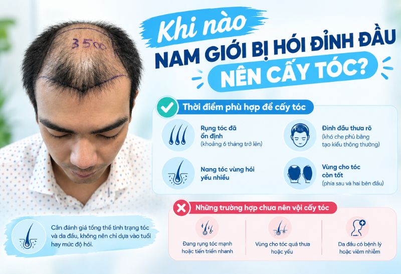 Khi nào nam giới bị hói đỉnh đầu nên cấy tóc 