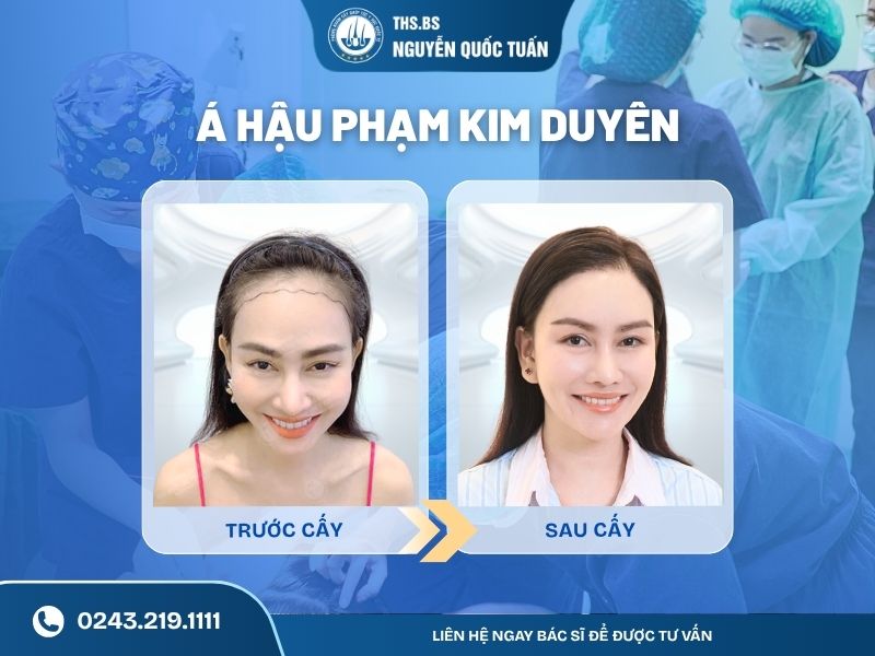  Á hậu Phạm Kim Duyên thực hiện 2 lần cấy đường chân tóc 