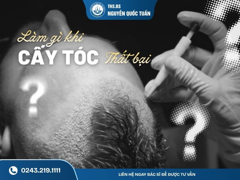 Làm gì sau cấy tóc thất bại