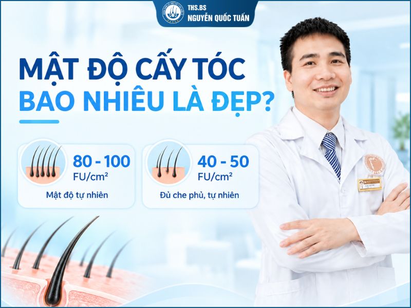 Mật độ cấy tóc bao nhiêu là đẹp