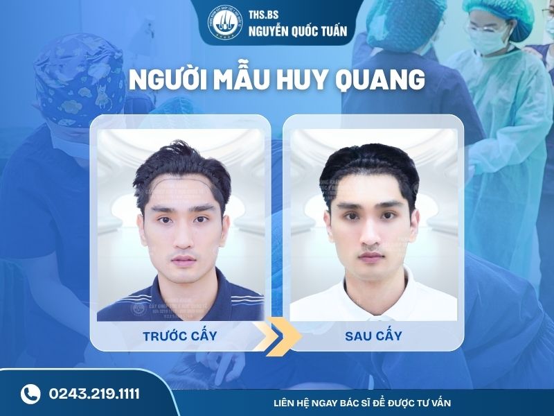 Kết quả sau cấy người mẫu Huy Quang 