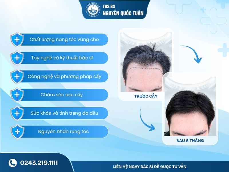 Những yếu tố nào quyết định tóc cấy duy trì lâu dài 
