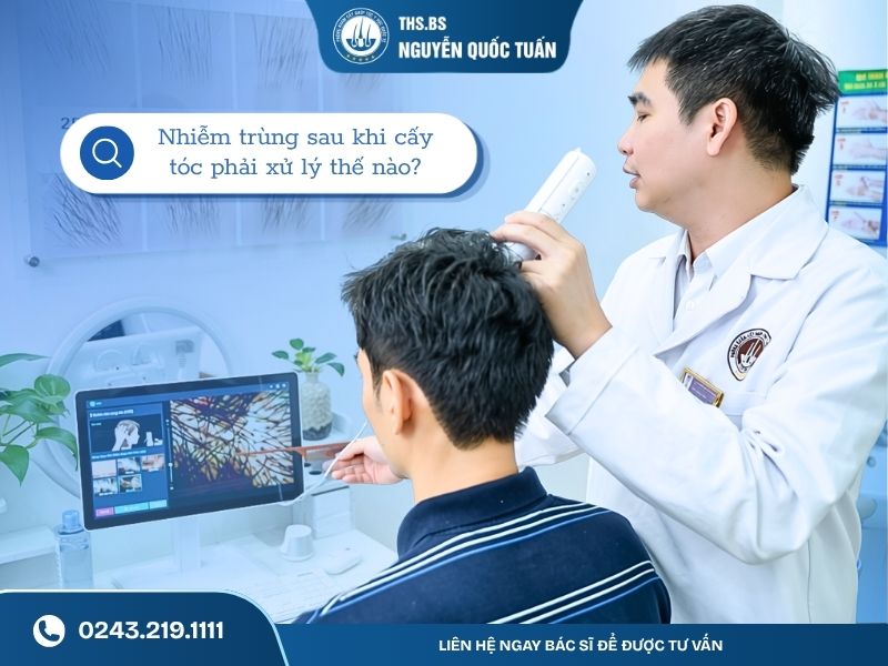 Nhiễm trùng sau khi cấy tóc phải xử lý thế nào 