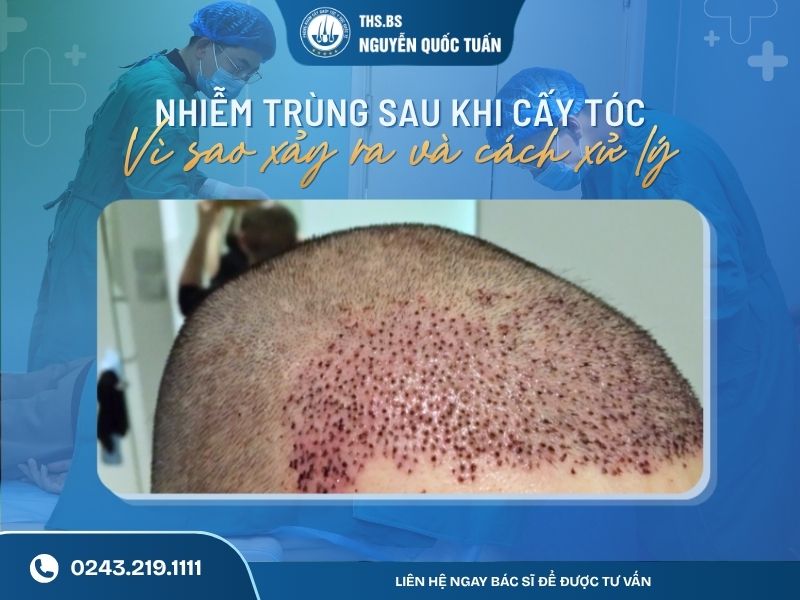 nhiễm trùng sau cấy tóc
