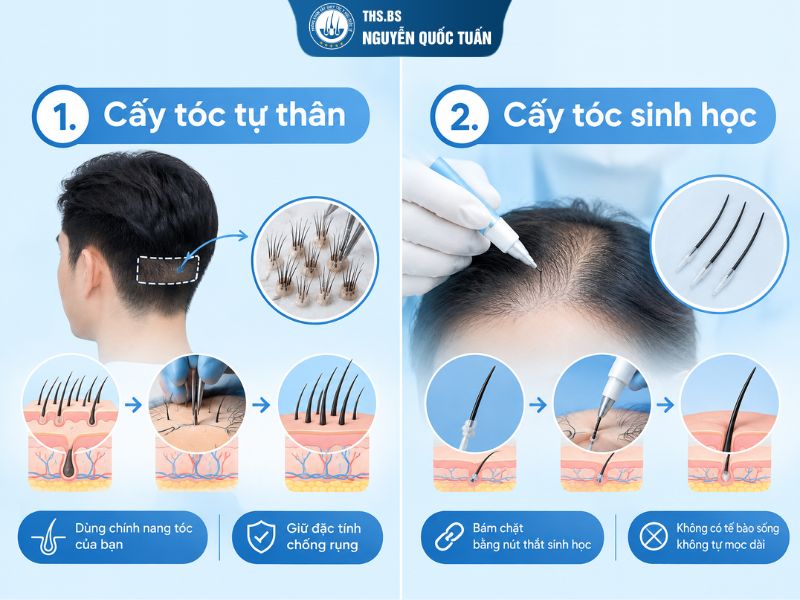 Cấy tóc tự thân và cấy tóc sinh học là gì? Hiểu đúng trước khi lựa chọn 