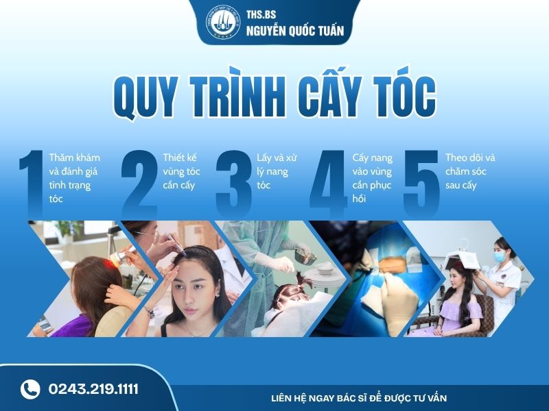 Quy trình cấy tóc được thực hiện như thế nào 