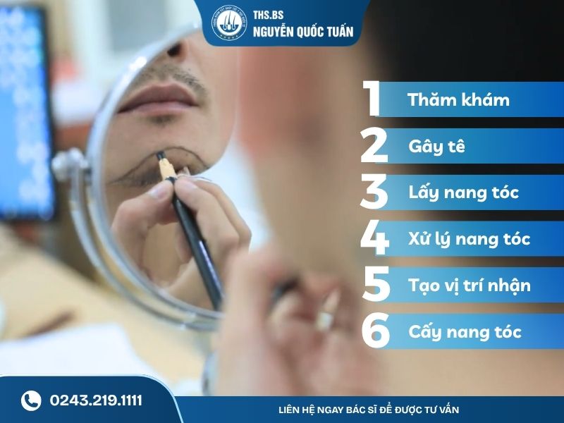 Quy trình thực hiện cấy râu  